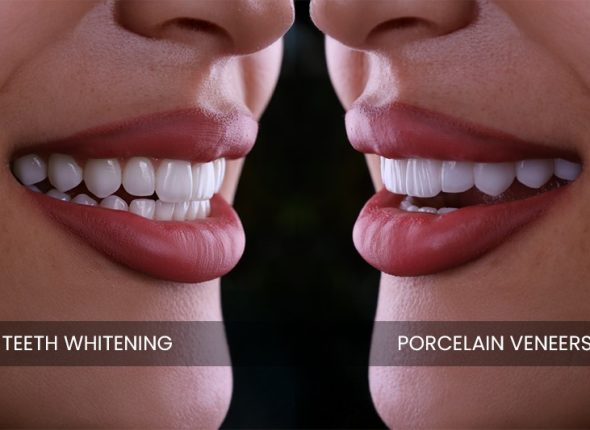 Emax Veneers vs Zirconium Crowns